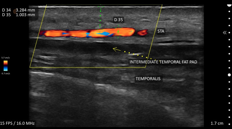 Clarius L20 - Arteria temporal superficial en estética